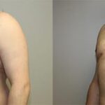 https://capizzimd.sbsdevserver.com/wp-content/uploads/2018/07/Gynecomastia-2-Front-Facing-Image-OP-GT.jpg