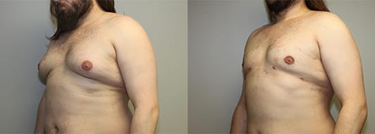 https://capizzimd.sbsdevserver.com/wp-content/uploads/2018/07/Gynecomastia-2-Front-Facing-Image-OP-GT.jpg