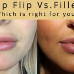 Comparing a Botox Lip Flip procedure to a lip filler treatment