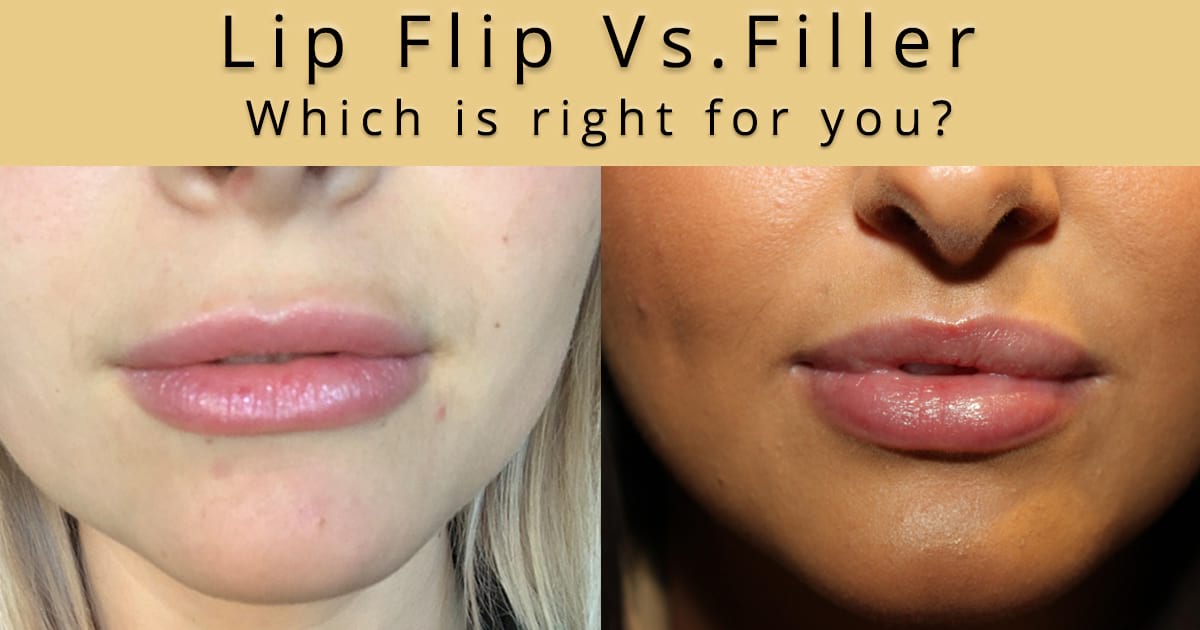 Comparing a Botox Lip Flip procedure to a lip filler treatment