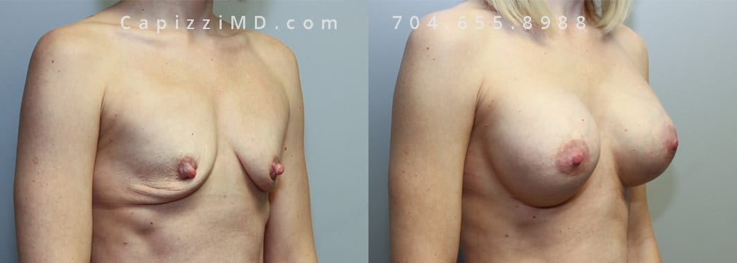 Breast Aug + Full Lift Sientra Textured Shaped Round Base High Projection 370cc. 1-year post-op. Oblique view.