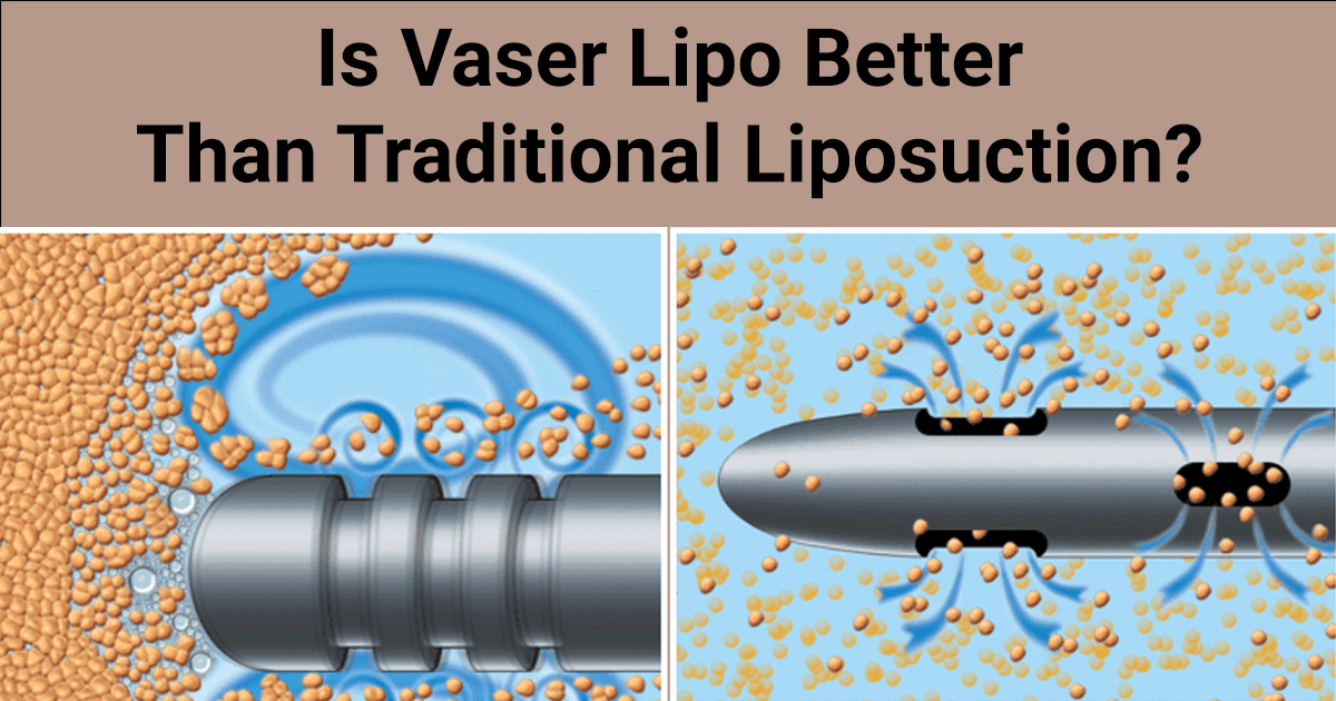 Vaser Lipo breaking up fat cells with ultrasound and traditional Liposuction tip sucking up fat cells.