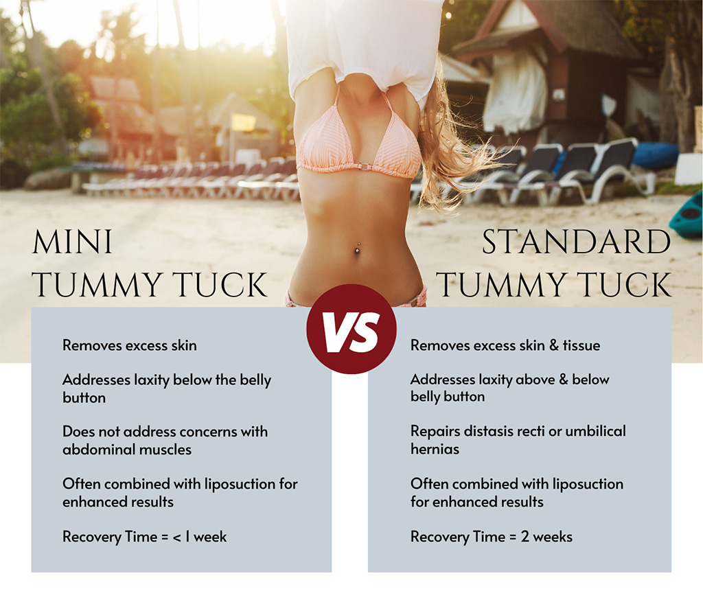 Mini Tummy Tuck comparison with Standard Tummy Tuck.