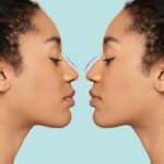 Before and After a Nose Job (Liquid Rhinoplasty) Mirror Image.