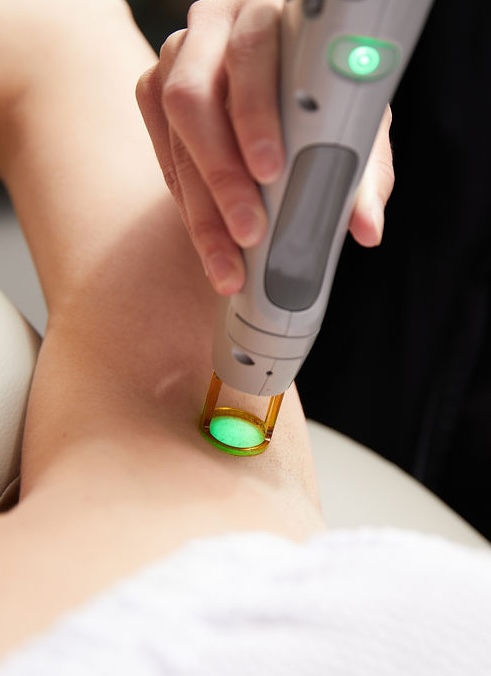 Laser Hair Removal