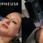 Is Radiofrequency RF Microneedling the Secret to Tighter-Skin?