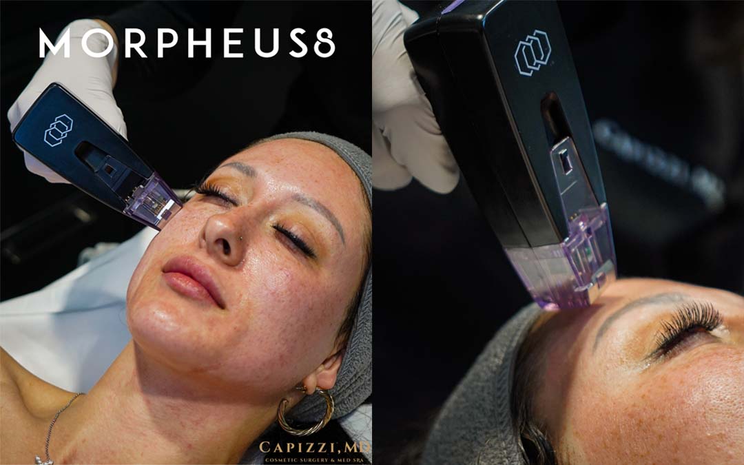 Is Radiofrequency RF Microneedling the Secret to Tighter-Skin?