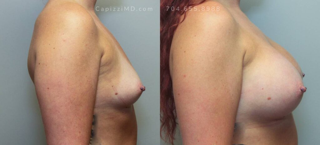 Breast Augmentation Gallery