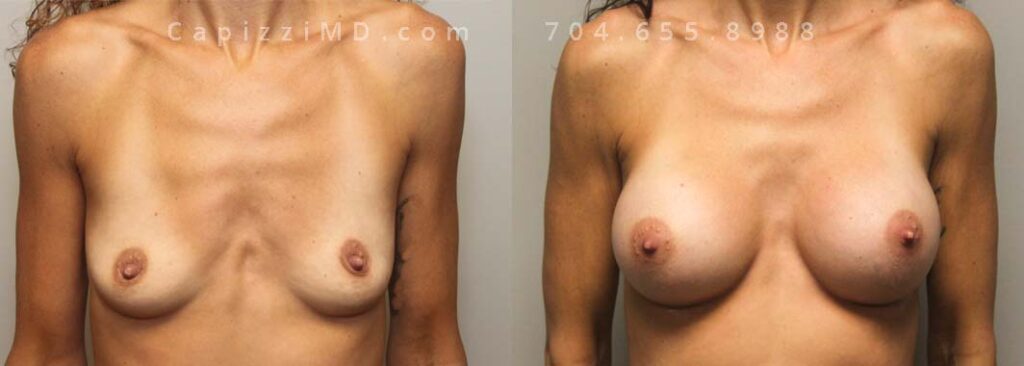 Breast Augmentation Gallery
