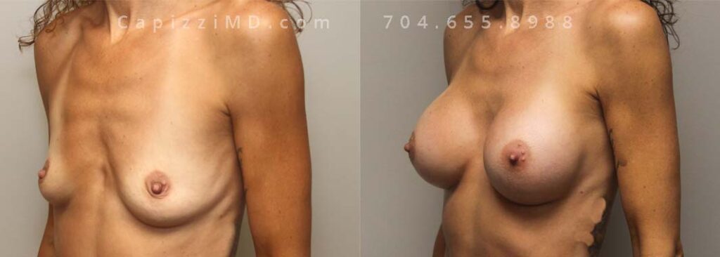 Breast Augmentation Gallery
