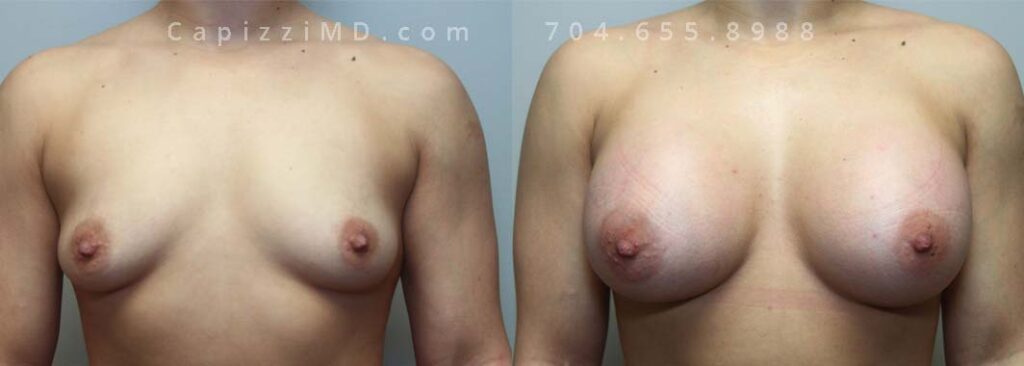 Breast Augmentation Gallery