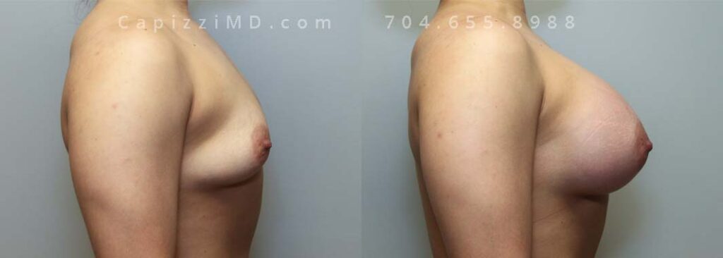 Breast Augmentation Gallery