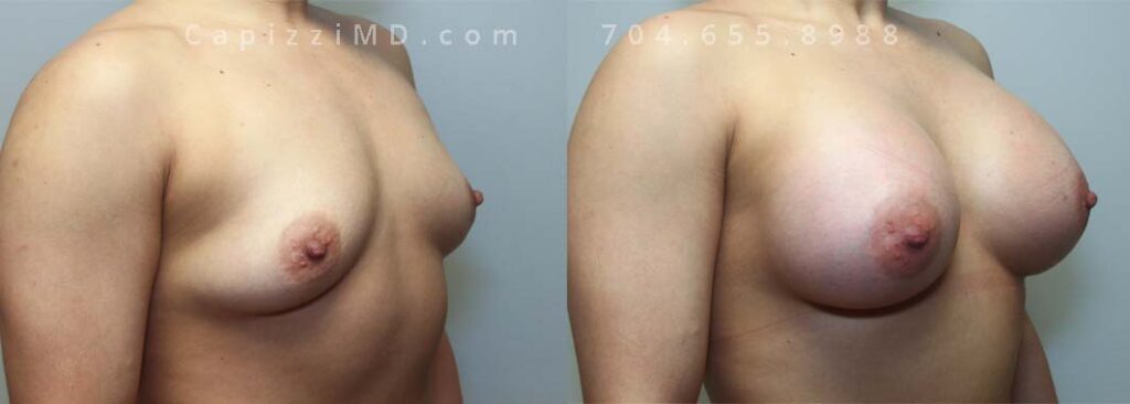 Breast Augmentation Gallery