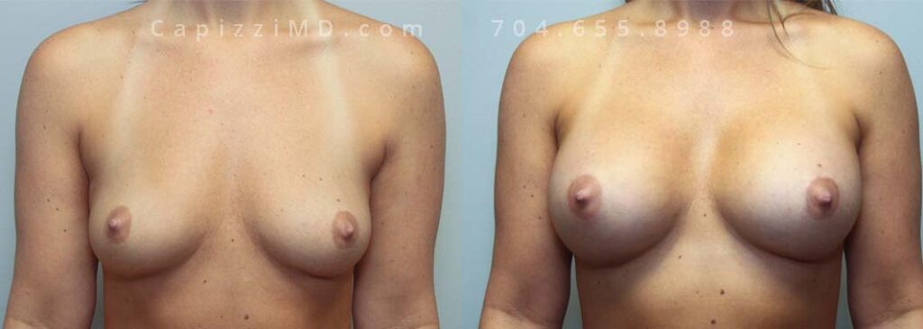 Breast Augmentation Gallery