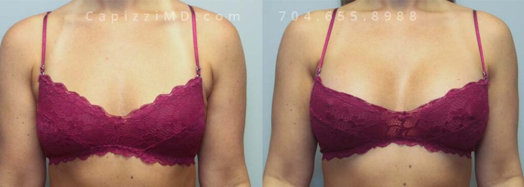 Breast Augmentation Gallery