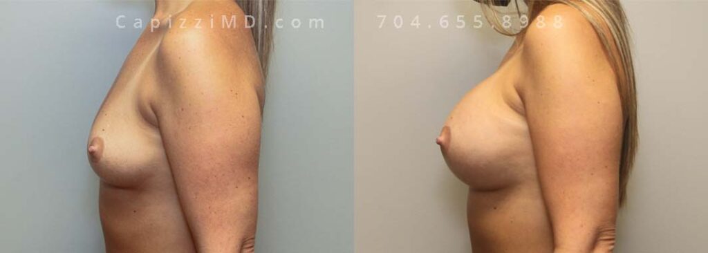 Breast Augmentation Gallery