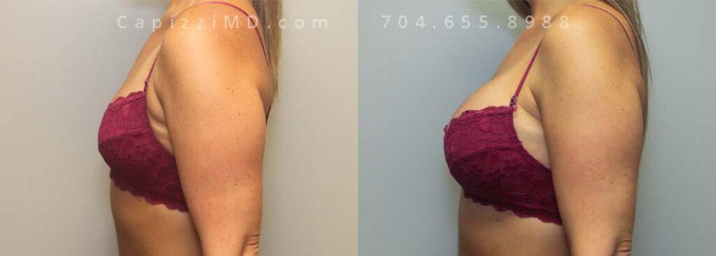 Breast Augmentation Gallery