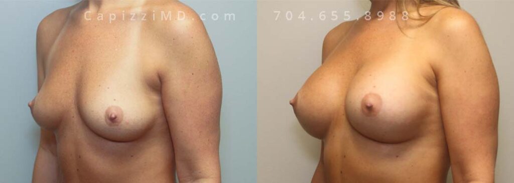 Breast Augmentation Gallery