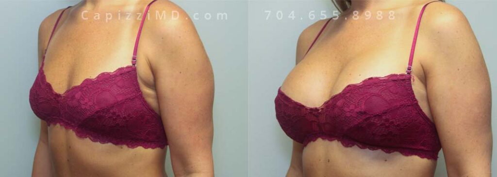 Breast Augmentation Gallery