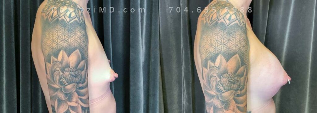 Breast Augmentation Gallery