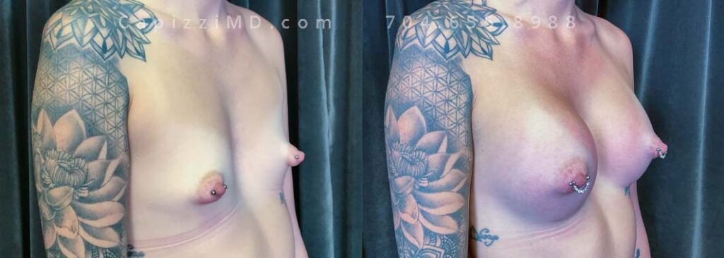 Breast Augmentation Gallery