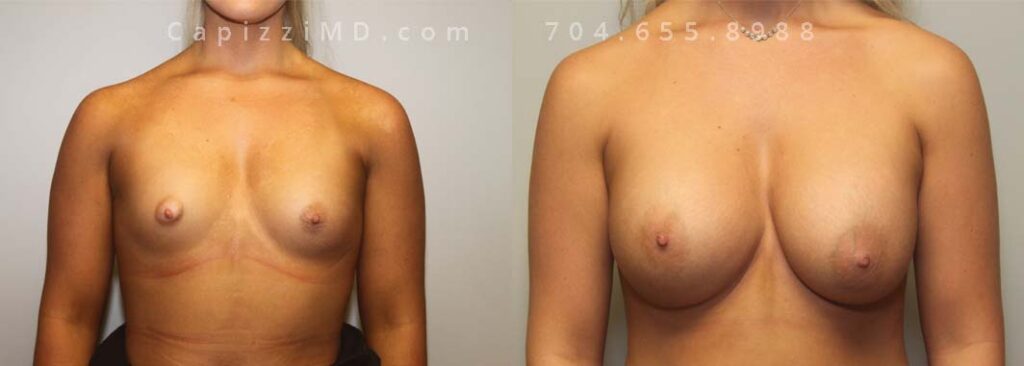 Breast Augmentation Gallery