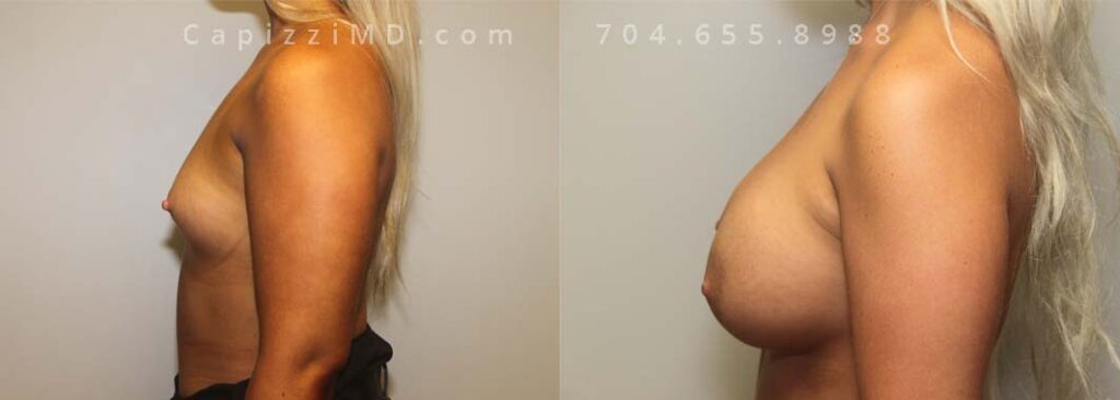 BreastAugmentation