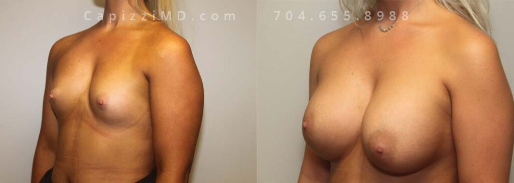 Breast Augmentation Gallery