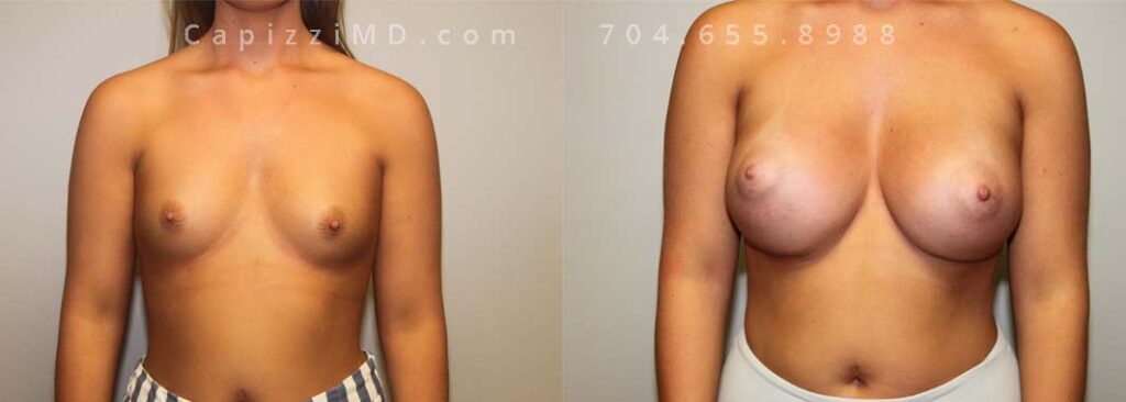 Breast Augmentation Gallery