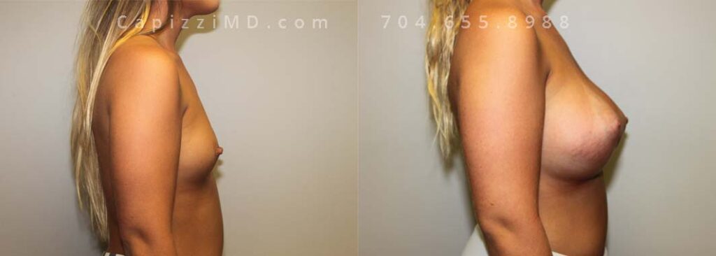 Breast Augmentation Gallery