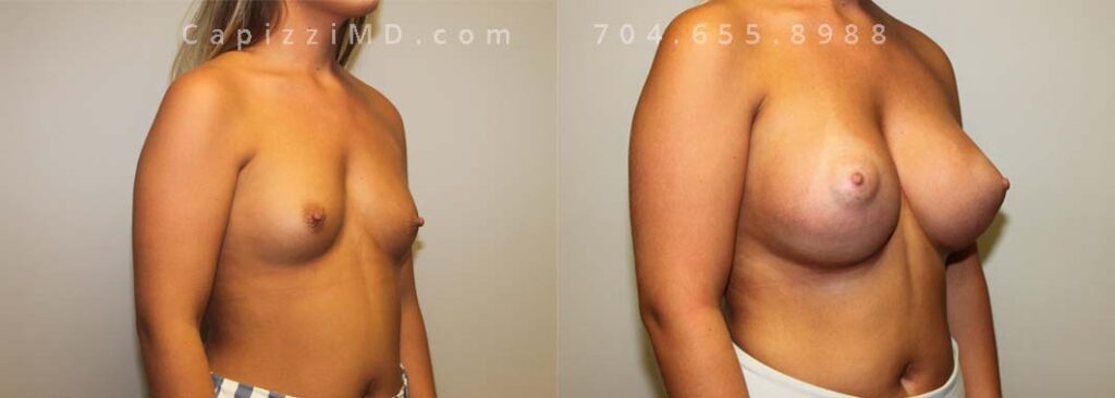 Breast Augmentation Gallery