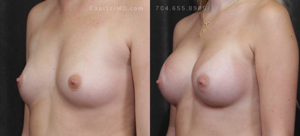 Breast Augmentation