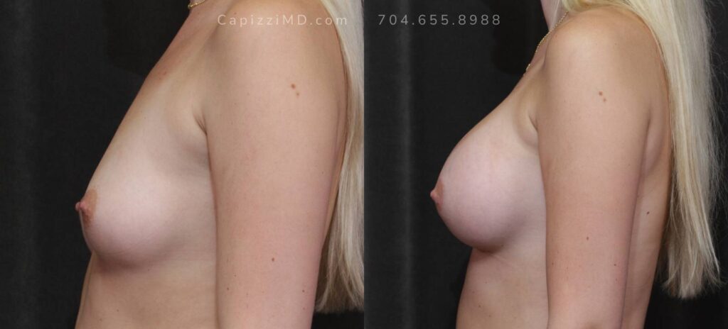 Breast Augmentation Gallery