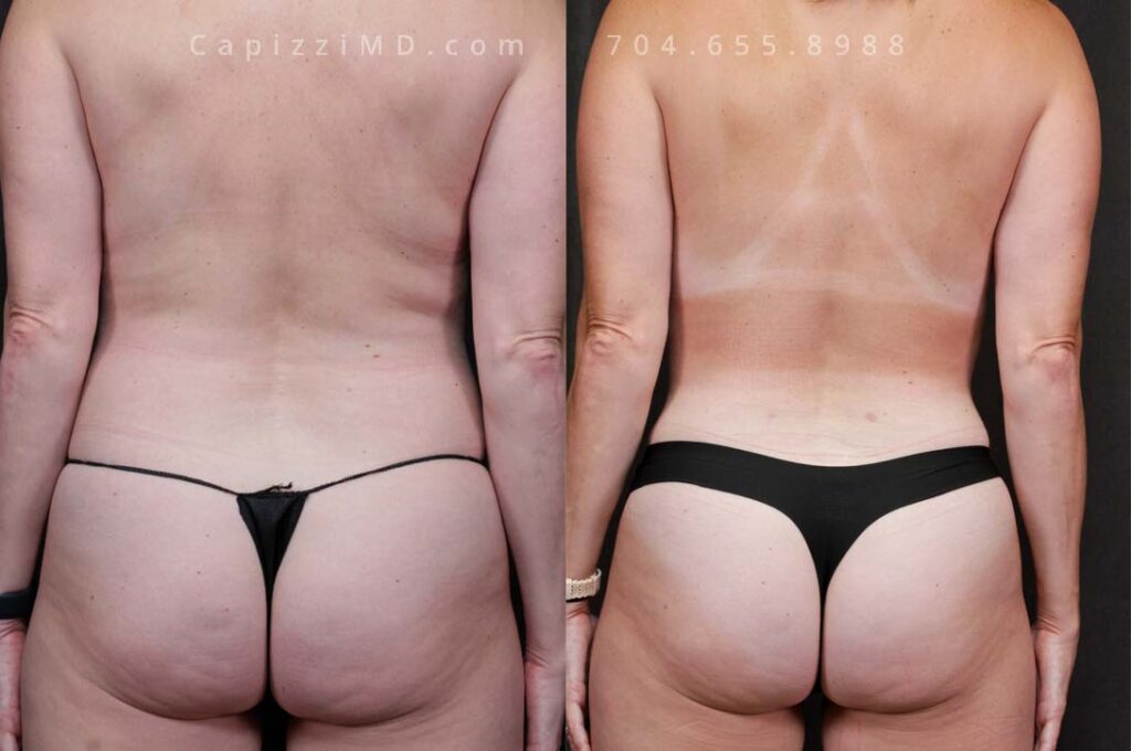 Breast Lift Gallery