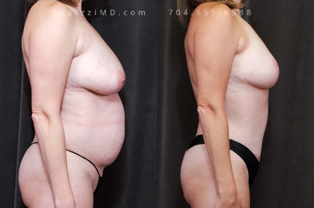 Breast Lift Gallery