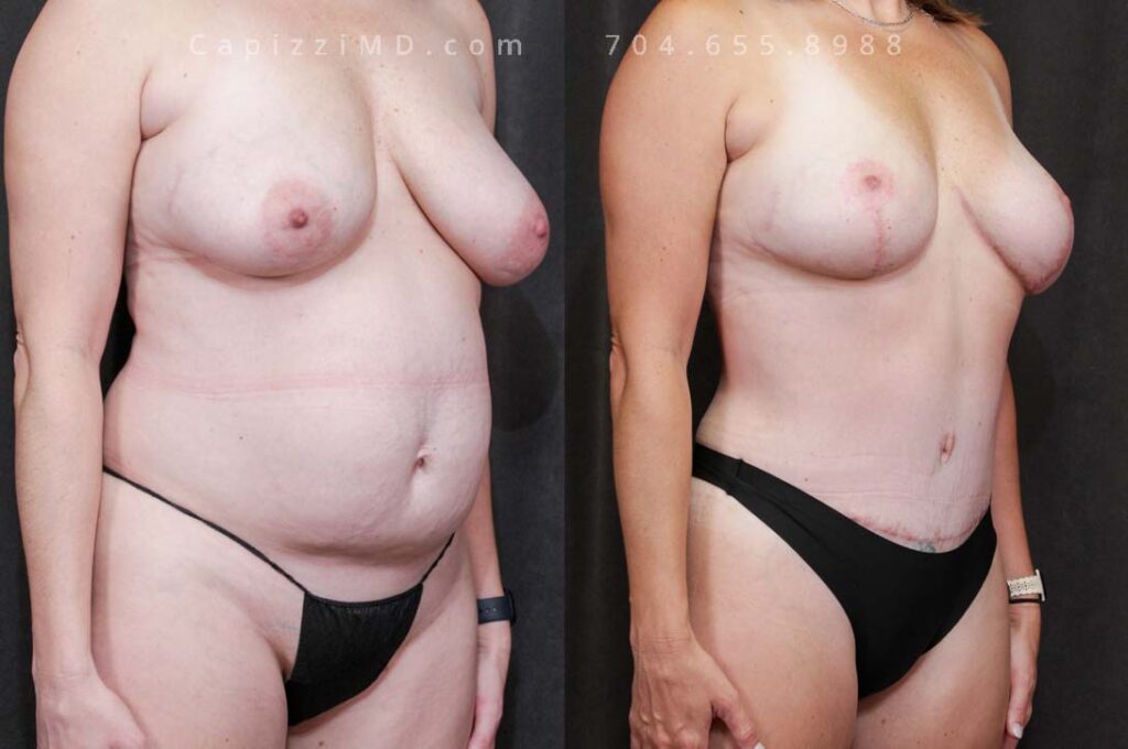 Breast Lift Gallery