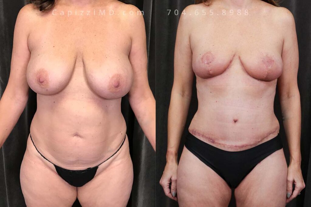 Breast Lift Gallery