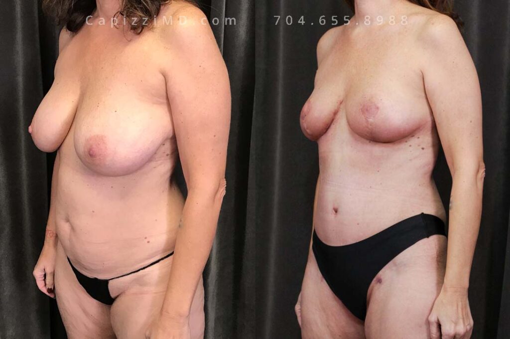 Breast Lift Gallery
