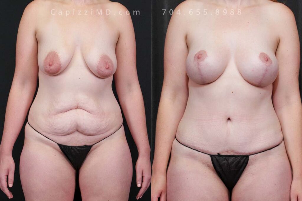 Breast Lift Gallery