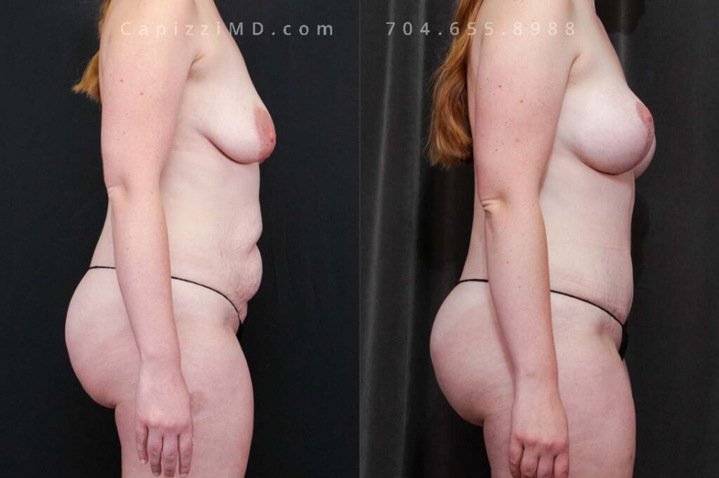 Breast Lift Gallery