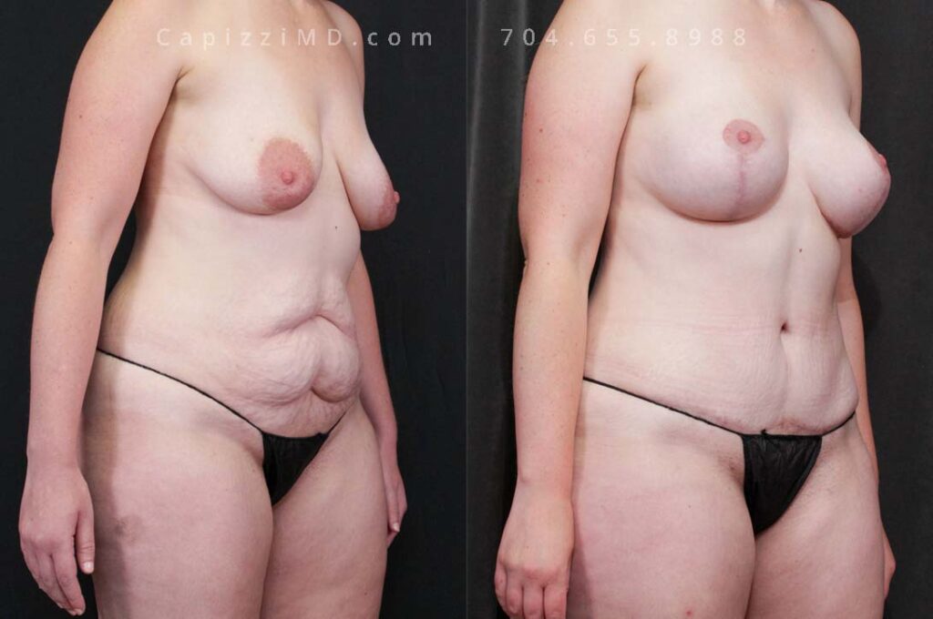 Breast Lift Gallery
