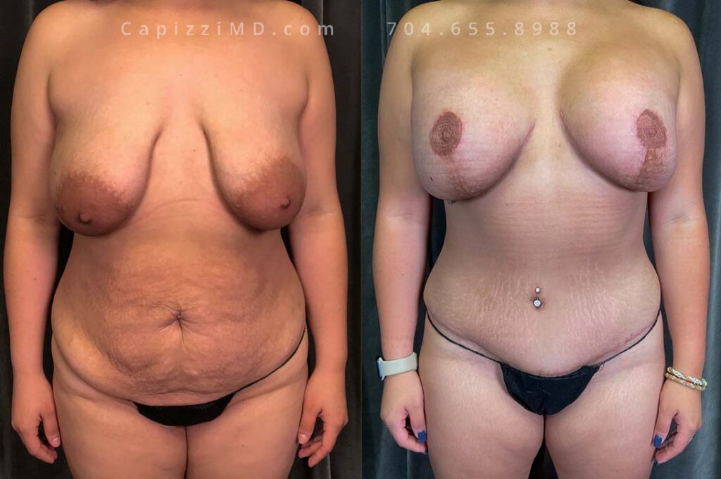 Breast Lift Gallery