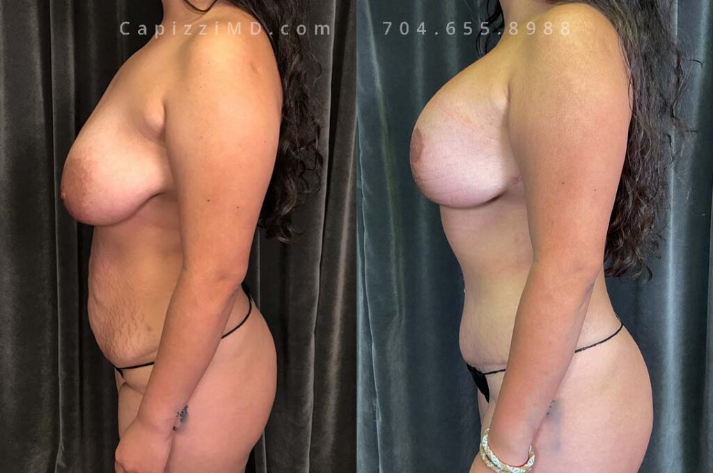 Breast Lift Gallery