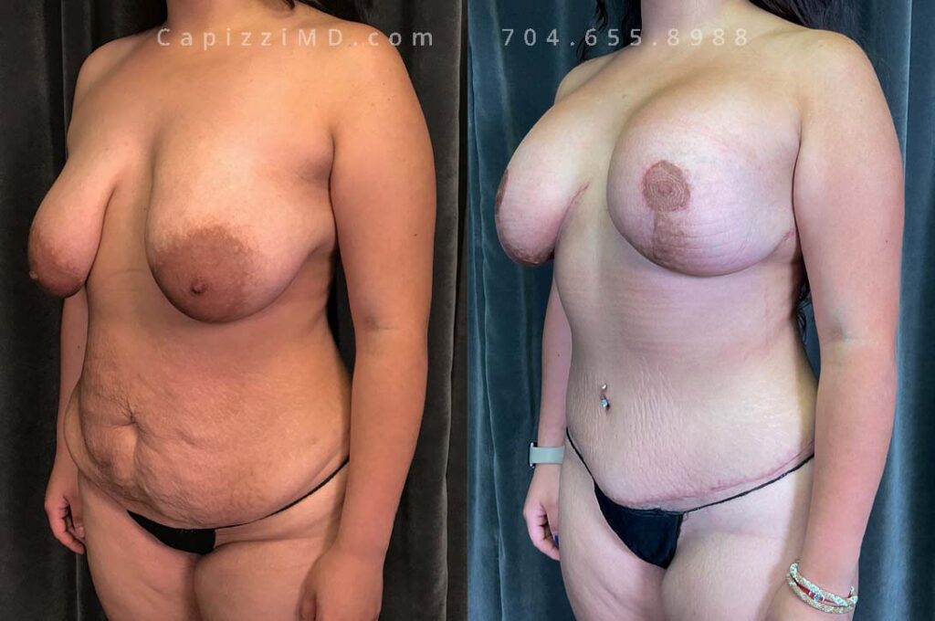 Breast Lift Gallery