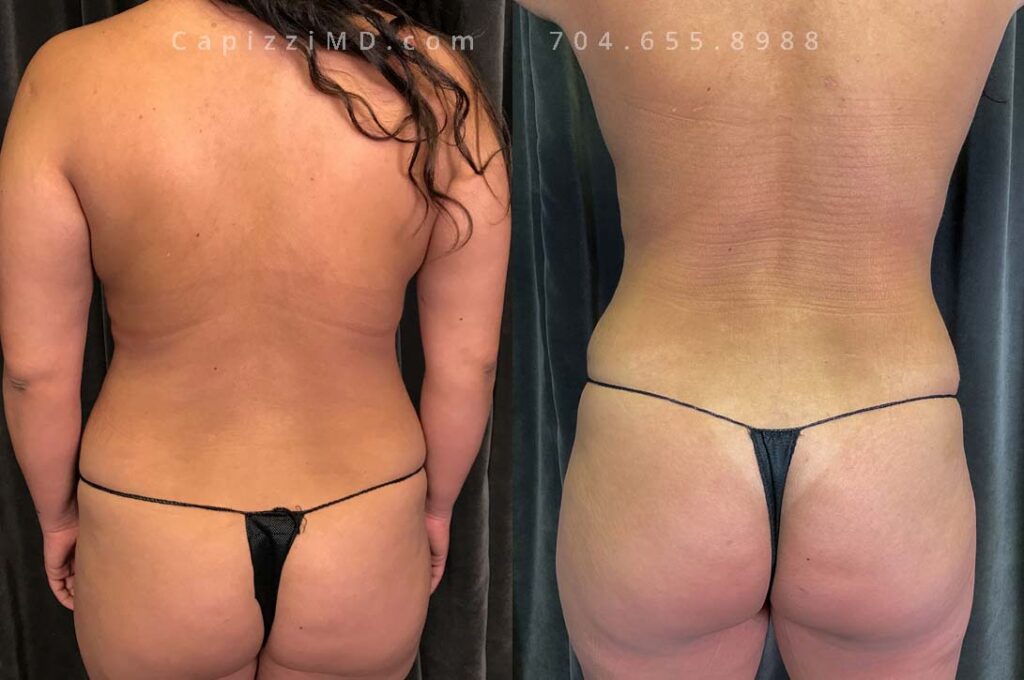 Breast Lift Gallery