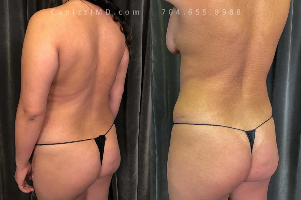 Breast Lift Gallery