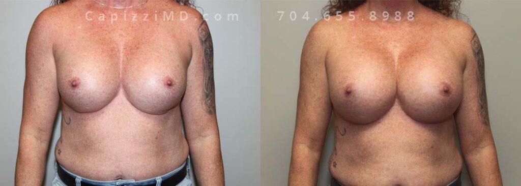 Breast Augmentation Gallery