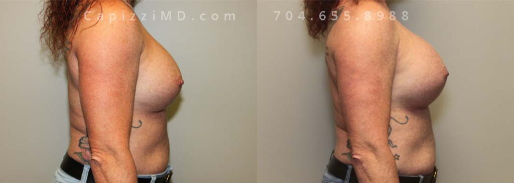 Breast Augmentation Gallery