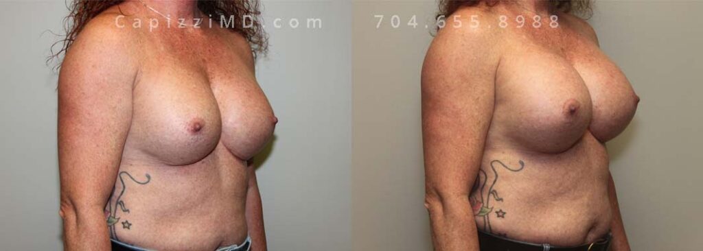 Breast Augmentation Gallery