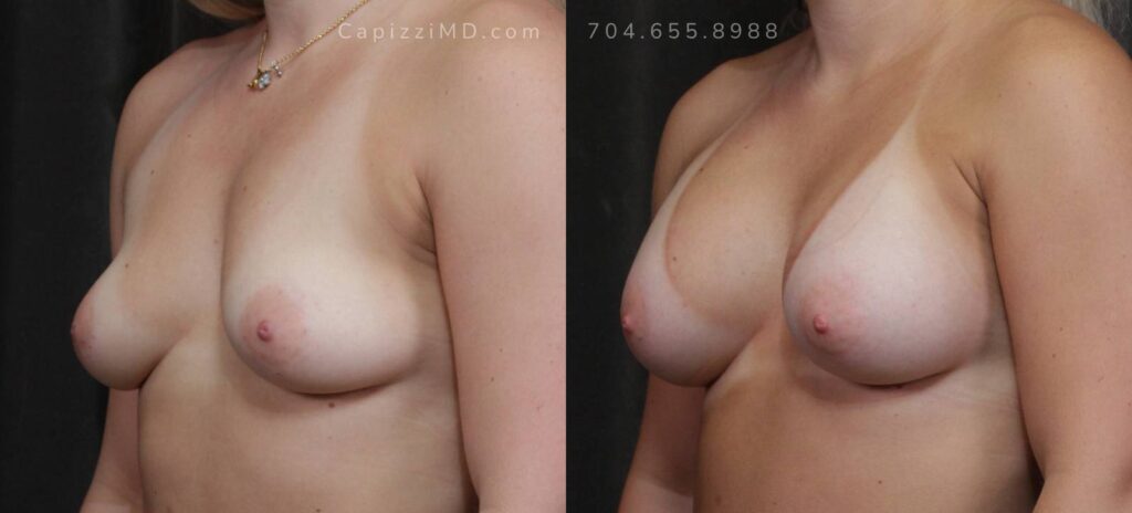 Breast Augmentation